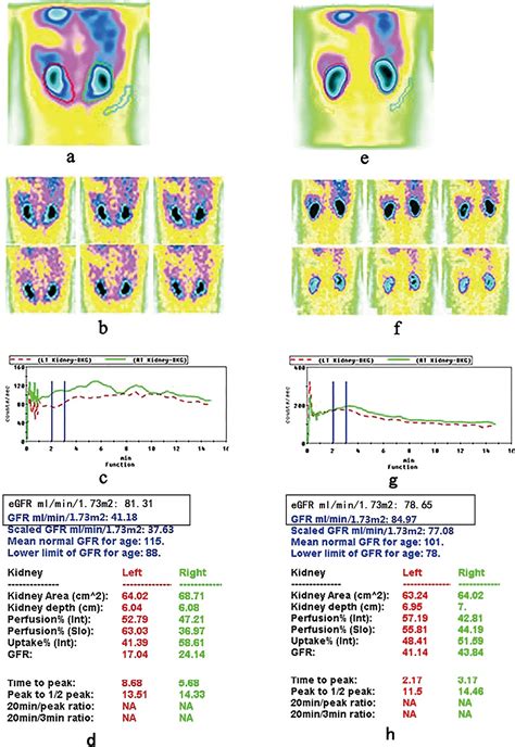 Glomerular filtration rate measured by 99mTc‐DTPA renal dynamic ima.